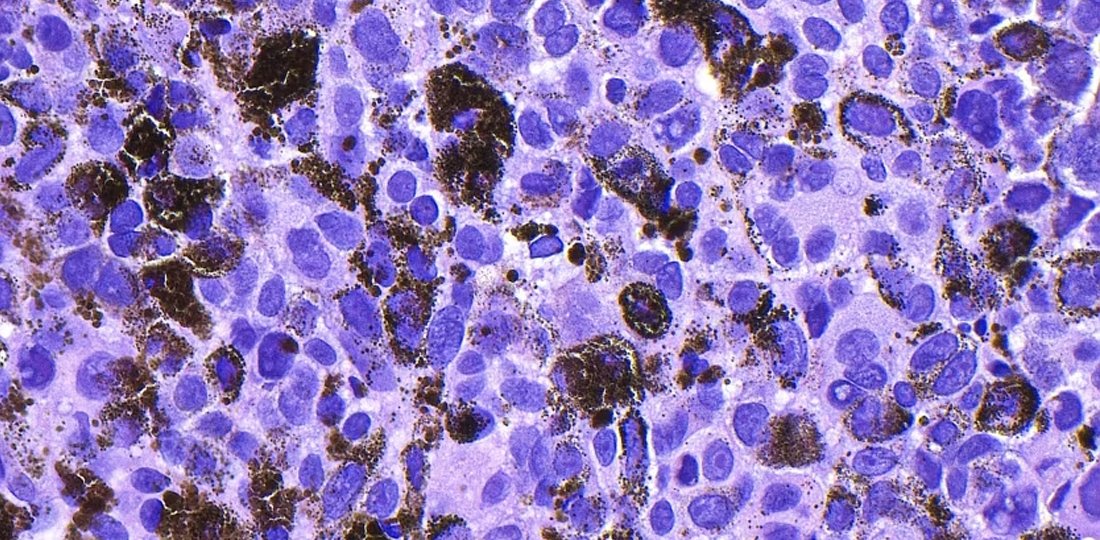 Moderna Cancer Vaccine Shows Promising Results in Melanoma Trial