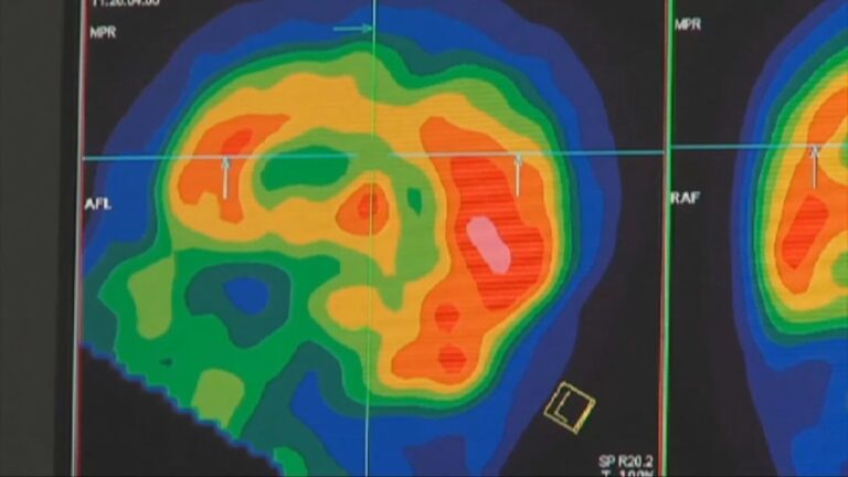 Neurologists urge earlier brain health steps ahead of World Alzheimer's Month