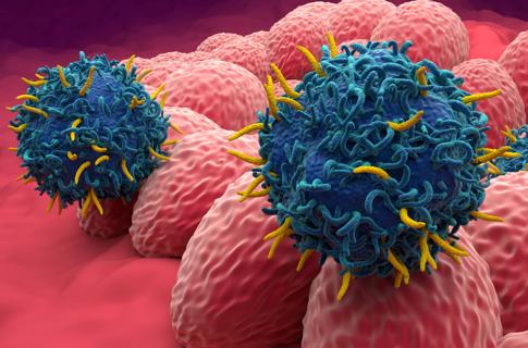 Medical illustration of endometrial cancer