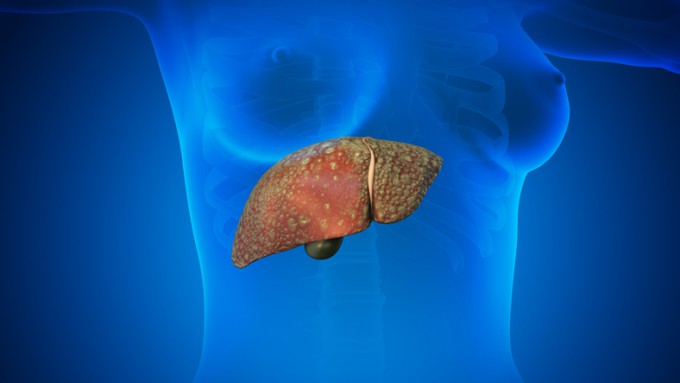 One in four Korean adults has metabolic dysfunction–associated fatty liver disease. Provided by Getty Image Bank
