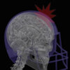After a concussion, the brain may no longer make sense of sounds