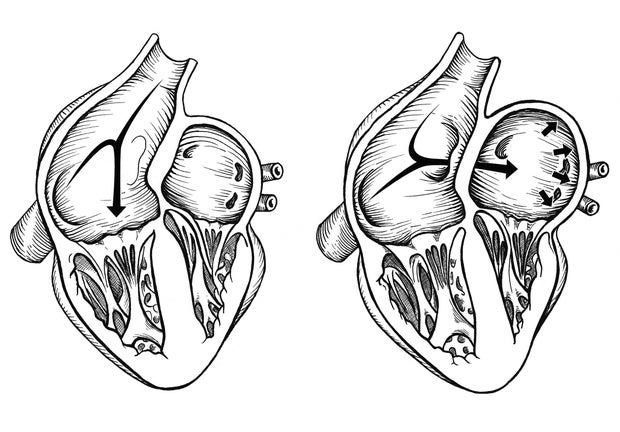Comparison of normal heart versus heart with a patent foramen ovale.