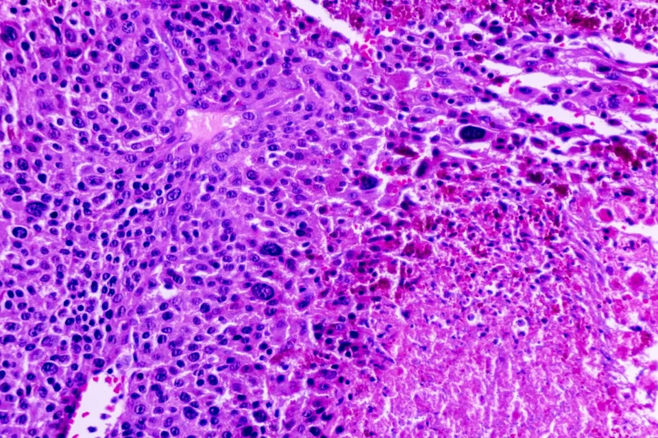 A microscopic view of squamous cell carcinoma from human cervical cancer, tissue section by H and E, is seen on Monday, March 24, 2025, in a pathology lab. (1535649680) arcyto – stock.adobe.com