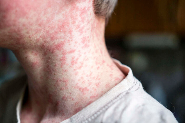 Public health officials warn of measles exposures in Richmond and Olive Hill