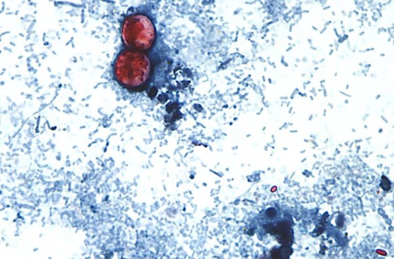 Why cyclospora can be deadly for some people Why cyclospora can be deadly for some people