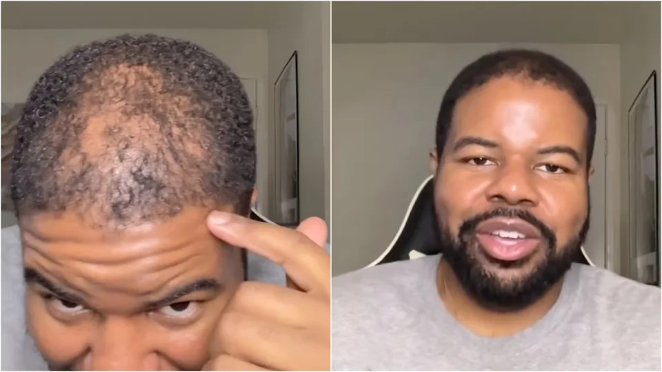 Mollett showed fans his five-month results as the new hair follicles continue to grow in. / Instagram/ Tyray Mollett
