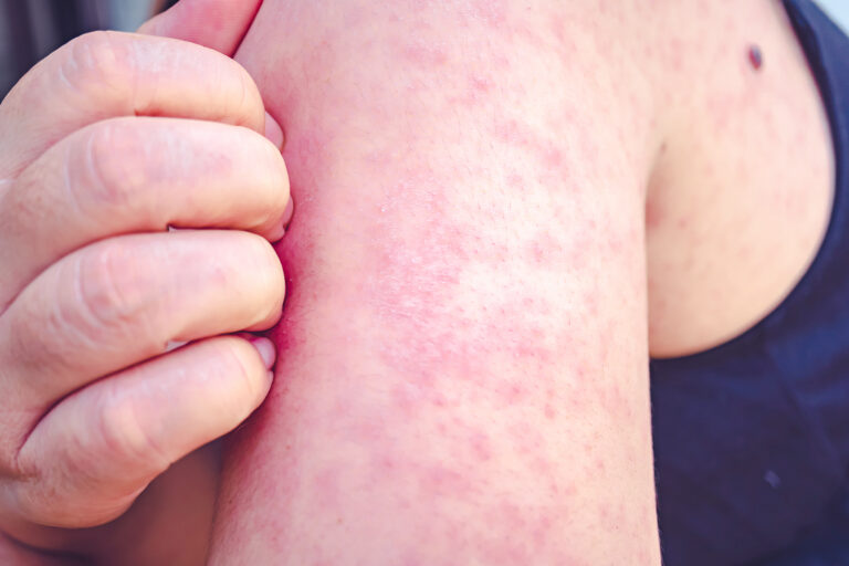 Measles outbreak grows in southwest Wisconsin Measles outbreak grows in southwest Wisconsin