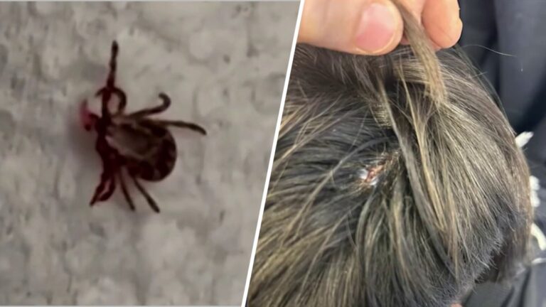Rare tick-borne illness has been found on Long Island. Doctors say symptoms can be intense