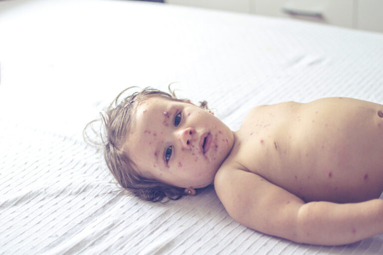 Measles spread in Wisconsin; almost everyone made ill is unvaccinated, health officials say Measles spread in Wisconsin; almost everyone made ill is unvaccinated, health officials say