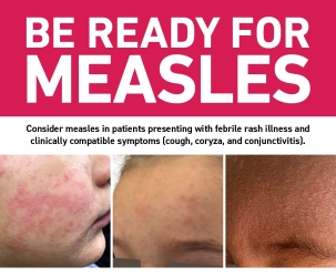 MEASLES UPDATE: Allegany County Department of Health Issues Updated Public Health Advisory MEASLES UPDATE: Allegany County Department of Health Issues Updated Public Health Advisory
