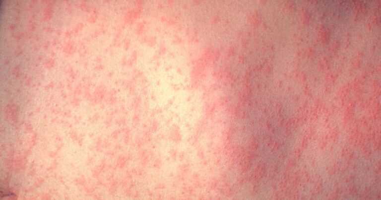 Illinois measles case, deaths in Pennsylvania prompt vaccination warning