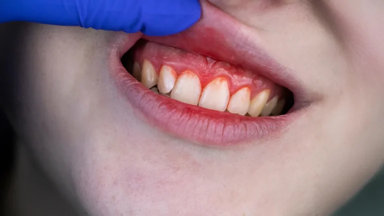Common supplements rival antibiotics for severe gum disease Common supplements rival antibiotics for severe gum disease