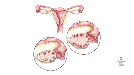 medical illustration of PCOS / PMOS