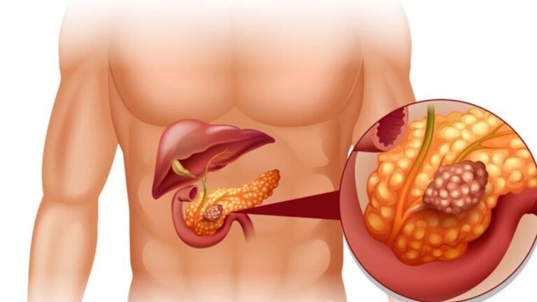 5 lifestyle changes a gastroenterologist recommends to prevent pancreatitis 5 lifestyle changes a gastroenterologist recommends to prevent pancreatitis