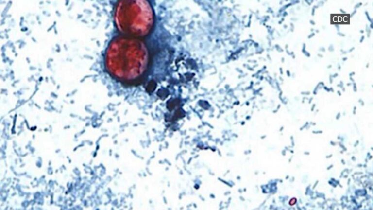 DPH: More 'explosive diarrhea' cases reported in SC; still not connected to national outbreak
