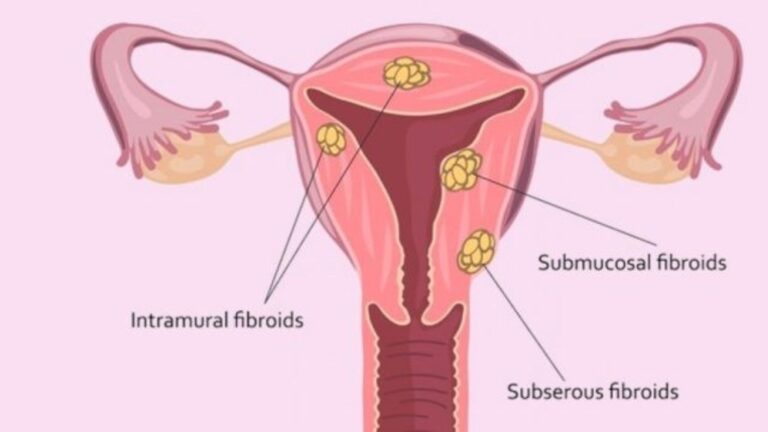 Beyond surgery: Can nutrition, lifestyle help prevent uterine fibroids? Beyond surgery: Can nutrition, lifestyle help prevent uterine fibroids?